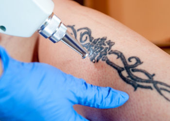Tattoo Removal